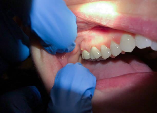 Best Chipped Tooth Repair Near Me  in Lithopolis, OH